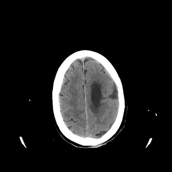 File:Cerebellar metastasis - lung tumor (Radiopaedia 69317-79145 Axial non-contrast 30).jpg