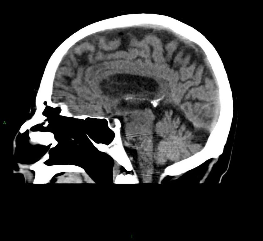 Cerebral amyloid angiopathy-associated lobar intracerebral hemorrhage (Radiopaedia 58376-65511 C 28).jpg