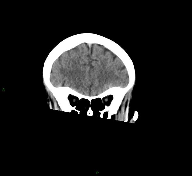 File:Cerebral amyloid angiopathy-associated lobar intracerebral hemorrhage (Radiopaedia 58378-65516 Coronal non-contrast 47).jpg