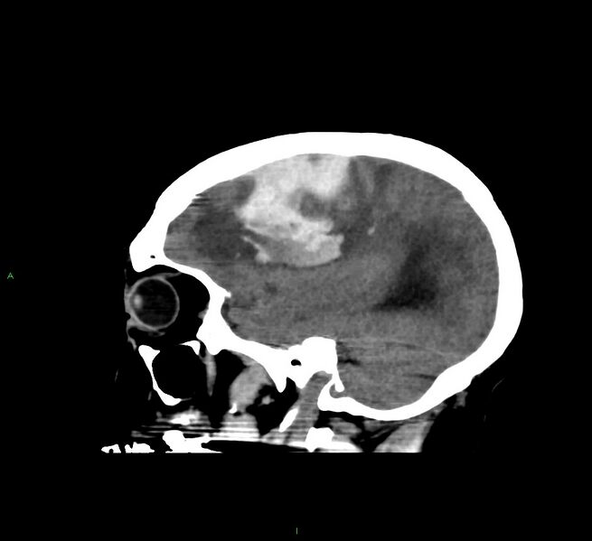 File:Cerebral amyloid angiopathy-associated lobar intracerebral hemorrhage (Radiopaedia 58560-65723 C 15).jpg