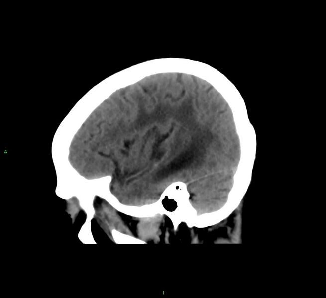 File:Cerebral amyloid angiopathy-associated lobar intracerebral hemorrhage (Radiopaedia 58561-65724 C 12).jpg