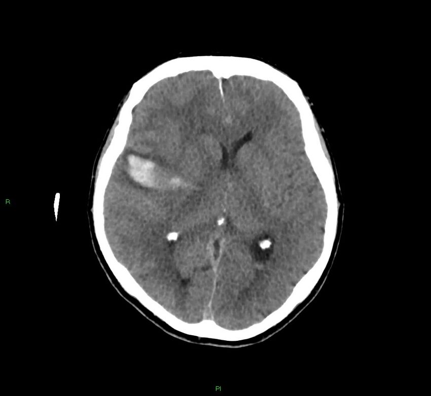 Cerebral amyloid angiopathy-associated lobar intracerebral hemorrhage (Radiopaedia 58756-65977 Axial non-contrast 28).jpg
