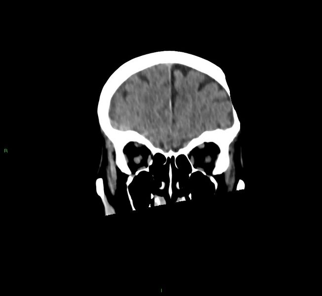 File:Cerebral amyloid angiopathy-associated lobar intracerebral hemorrhage (Radiopaedia 58758-65980 Coronal non-contrast 50).jpg