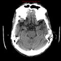 Cerebral and orbital tuberculomas (Radiopaedia 13308-13310 Axial non-contrast 29).jpg