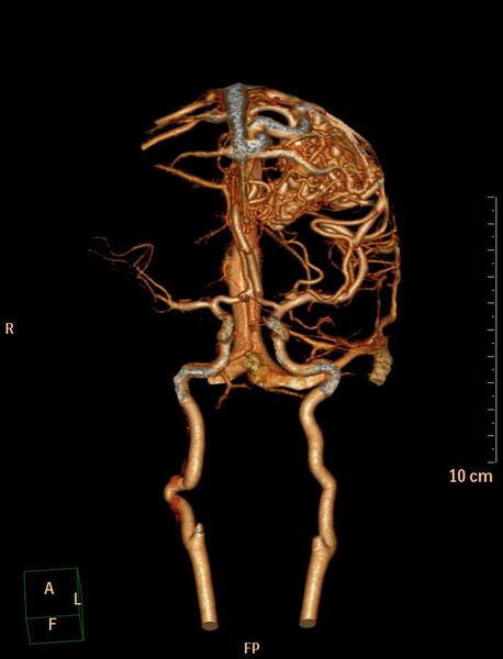 File:Cerebral arteriovenous malformation (Radiopaedia 29531-30031 B 1).jpg