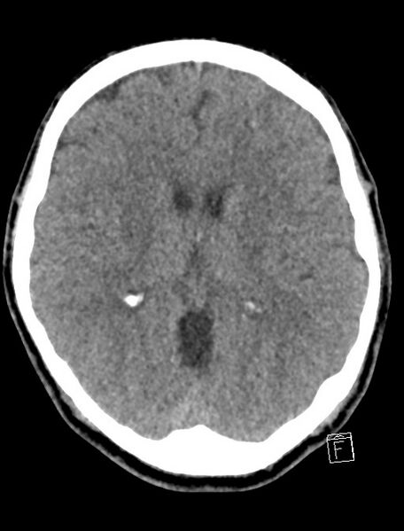 File:Cerebral arteriovenous malformation (Radiopaedia 78188-90745 Axial non-contrast 13).jpg