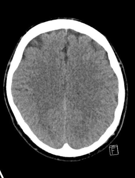 File:Cerebral arteriovenous malformation (Radiopaedia 78188-90745 Axial non-contrast 16).jpg