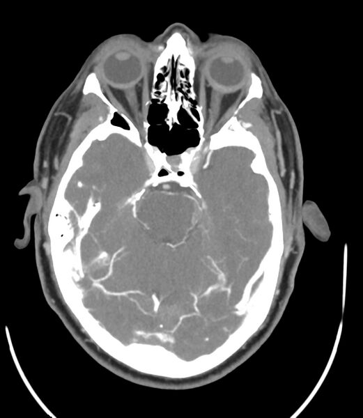 File:Cerebral dural venous sinus thrombosis (Radiopaedia 86514-102576 A 43).jpg