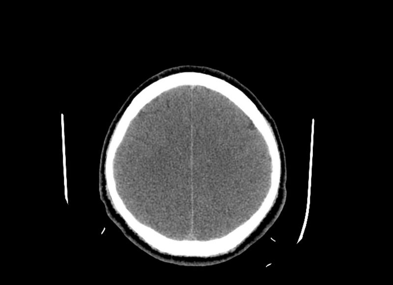 File:Cerebral edema (Radiopaedia 82519-96661 Axial non-contrast 16).jpg