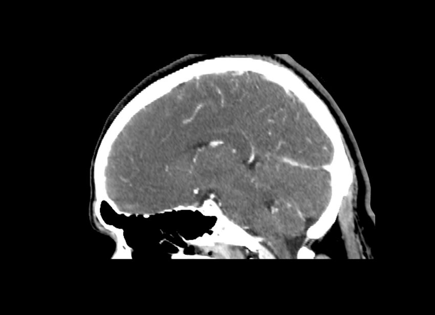 Cerebral edema (Radiopaedia 82519-96661 D 30).jpg
