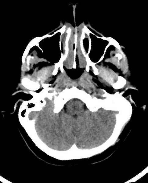 File:Cerebral edema due to severe hyponatremia (Radiopaedia 89826-106938 Axial non-contrast 19).jpg