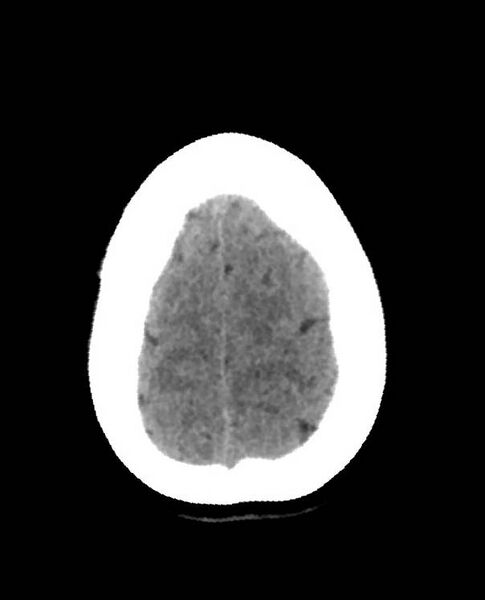 File:Cerebral edema due to severe hyponatremia (Radiopaedia 89826-106938 Axial non-contrast 89).jpg