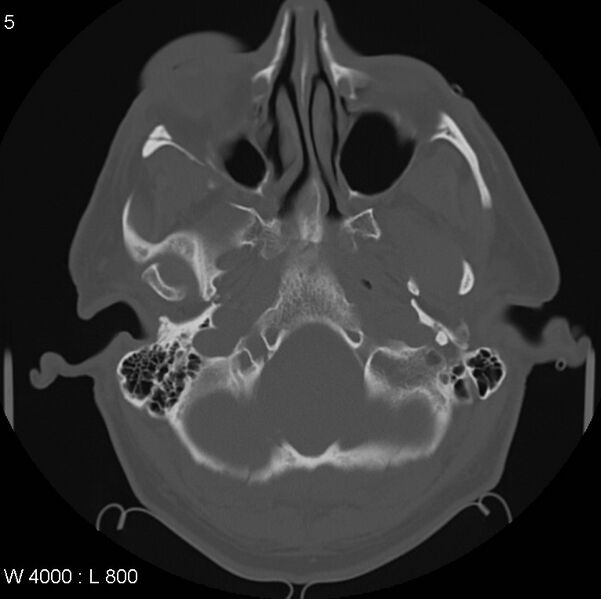 File:Cerebral hemorrhagic contusion with subdural and subarachnoid hemorrhage (Radiopaedia 10680-11146 Axial bone window 5).jpg