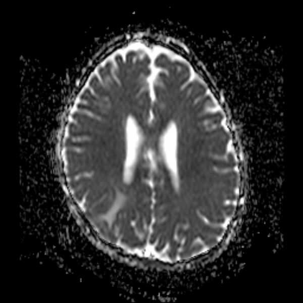 File:Cerebral tuberculoma (Radiopaedia 41152-43932 Axial ADC 15).jpg