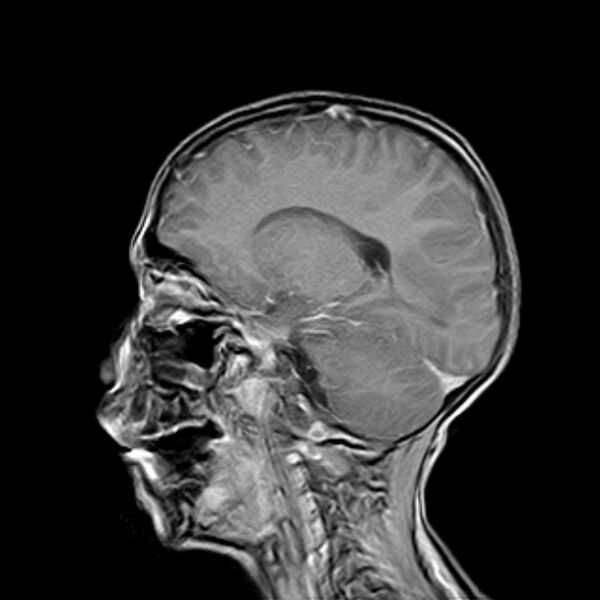 File:Cerebral tuberculoma (Radiopaedia 41152-43932 Sagittal T1 C+ 12).jpg