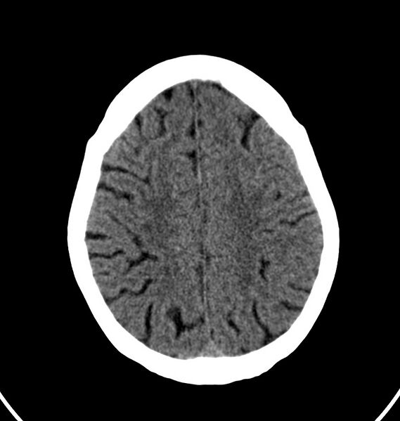 File:Cerebral venous thrombosis - CT only (Radiopaedia 41031-43778 Axial non-contrast 19).jpg
