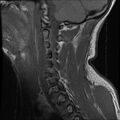 Cervical flexion teardrop fracture with cord hemorrhage (Radiopaedia 32497-33455 Sagittal T1 13).jpg