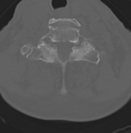 Cervical spondylolysis (Radiopaedia 49616-54811 Axial bone window 42).png