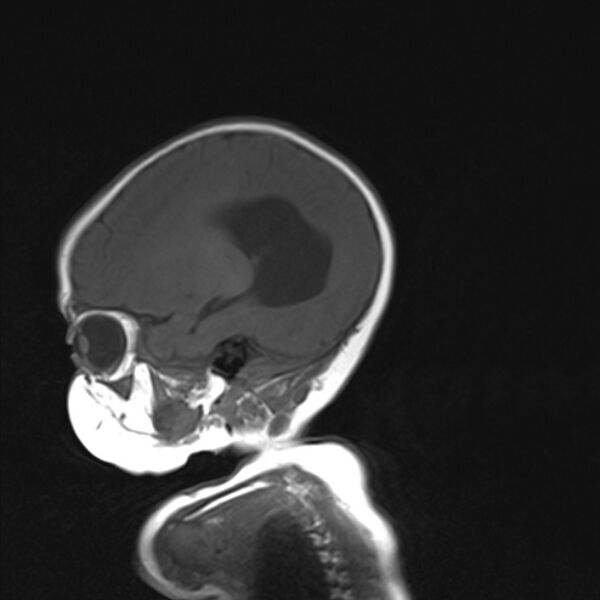 File:Chiari III malformation with occipital encephalocele (Radiopaedia 79446-92559 Sagittal T1 7).jpg