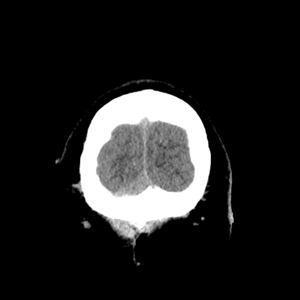 File:Chiasmatic-hypothalamic juvenile pilocytic astrocytoma (Radiopaedia 78533-91237 Coronal non-contrast 64).jpg