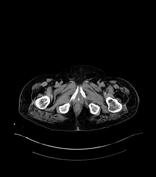 File:Cholangiocarcinoma with cerebral metastases (Radiopaedia 83519-98629 Axial non-contrast 132).jpg