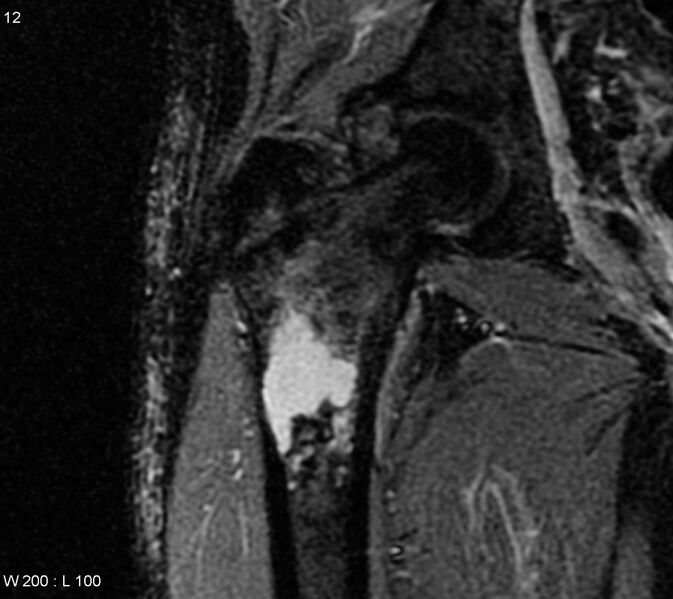 File:Chondrosarcoma - proximal femur (Radiopaedia 6171-7623 Coronal STIR 1).jpg