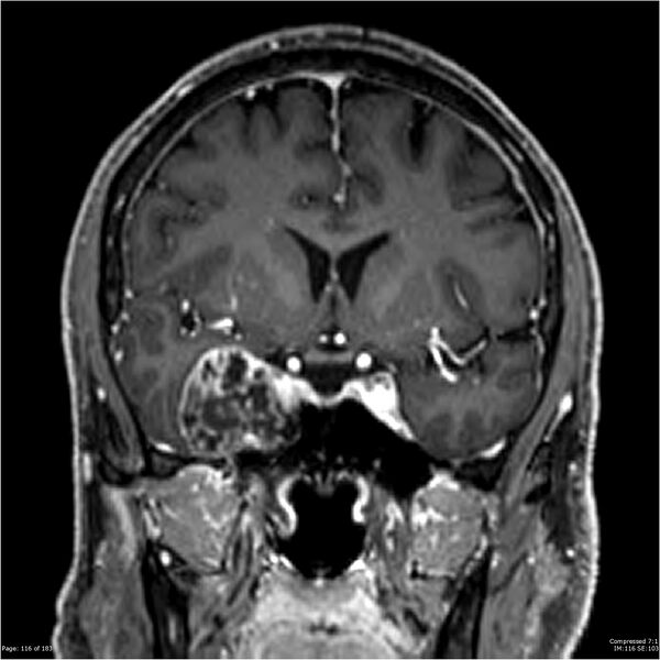 File:Chondrosarcoma of skull base- grade II (Radiopaedia 40948-43654 Coronal T1 C+ 27).jpg