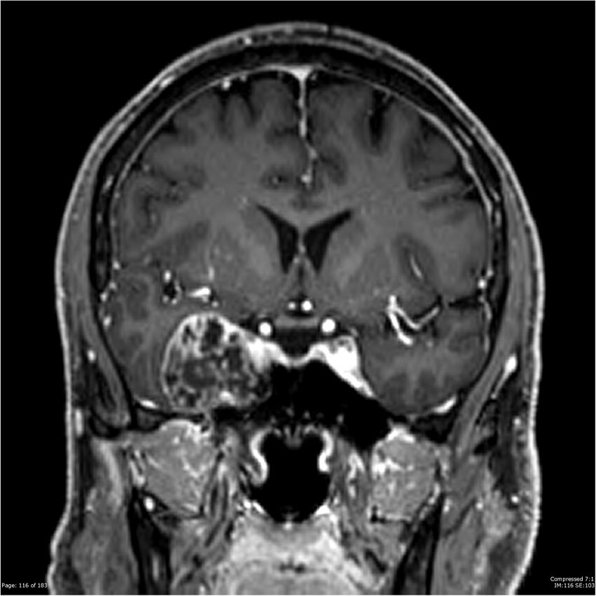 Chondrosarcoma of skull base- grade II (Radiopaedia 40948-43654 Coronal T1 C+ 27).jpg