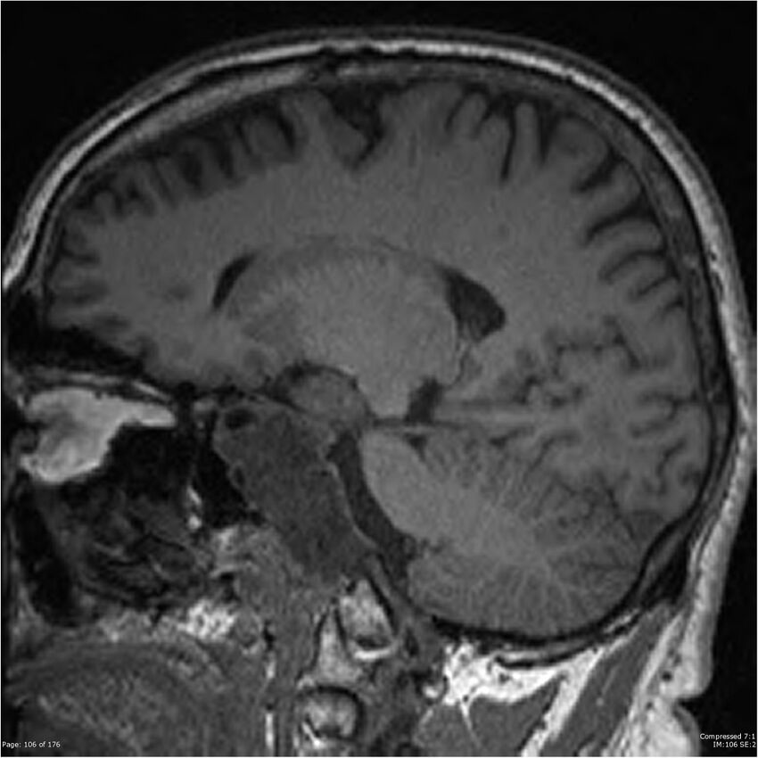 Chondrosarcoma of skull base- grade II (Radiopaedia 40948-43654 Sagittal T1 29).jpg