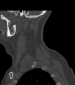 Chordoma (C4 vertebra) (Radiopaedia 47561-52188 Sagittal bone window 10).png