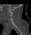 Chordoma (C4 vertebra) (Radiopaedia 47561-52188 Sagittal bone window 51).png