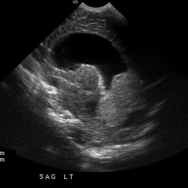 File:Choroid plexus carcinoma (Radiopaedia 21121-21033 A 15).jpg
