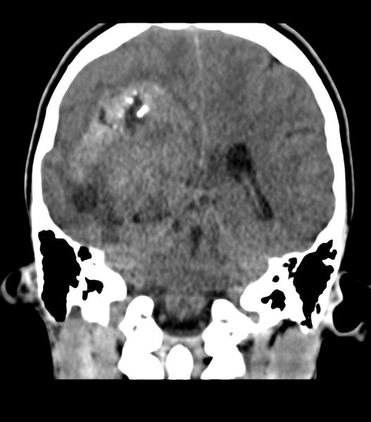 File:Choroid plexus carcinoma (Radiopaedia 91013-108552 Coronal non-contrast 55).jpg