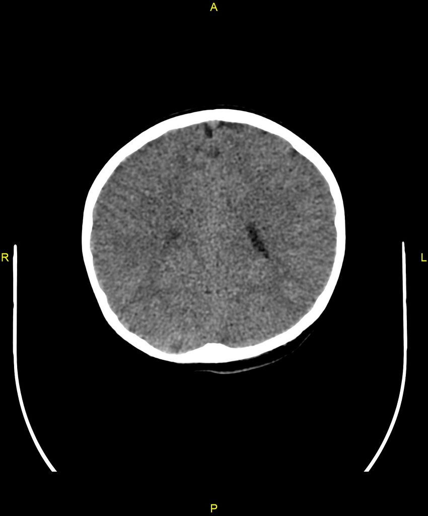 Choroidal fissure cyst (Radiopaedia 89481-106465 Axial non-contrast 81).jpg