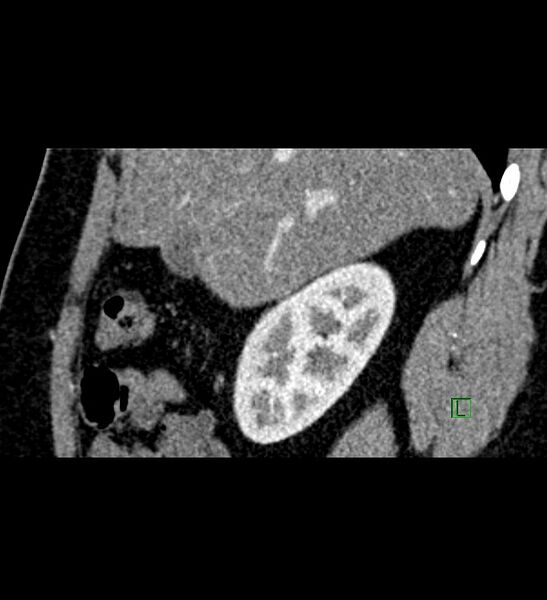 File:Chromophobe renal cell carcinoma (Radiopaedia 84286-99573 F 127).jpg