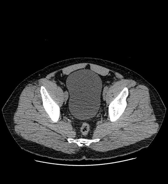 File:Chromophobe renal cell carcinoma (Radiopaedia 84337-99693 Axial non-contrast 139).jpg