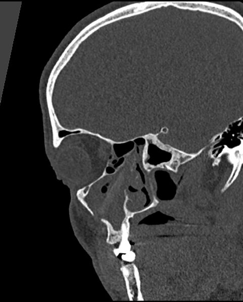 File:Chronic maxillary sinusitis caused by a foreign body (Radiopaedia 58521-65676 Sagittal bone window 17).jpg