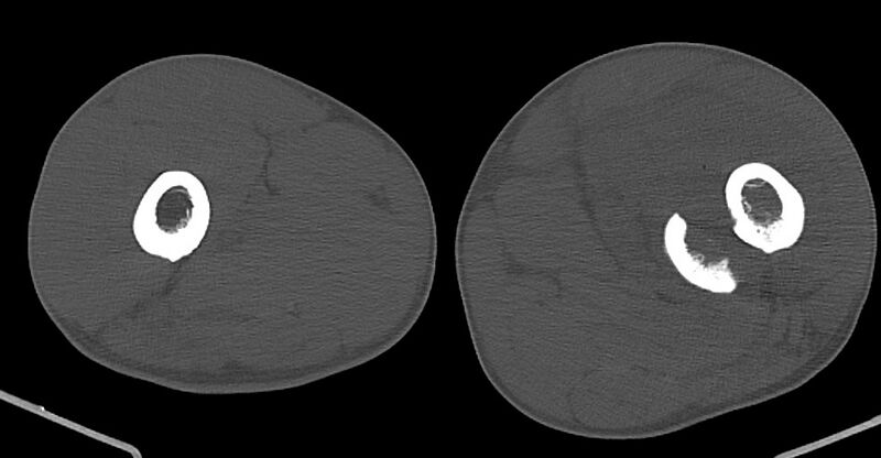 File:Chronic osteomyelitis (with sequestrum) (Radiopaedia 74813-85822 Axial non-contrast 80).jpg
