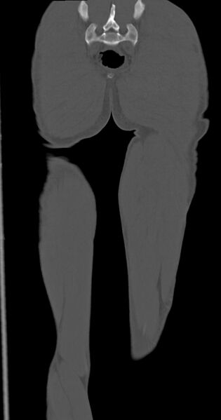 File:Chronic osteomyelitis (with sequestrum) (Radiopaedia 74813-85822 Coronal non-contrast 50).jpg