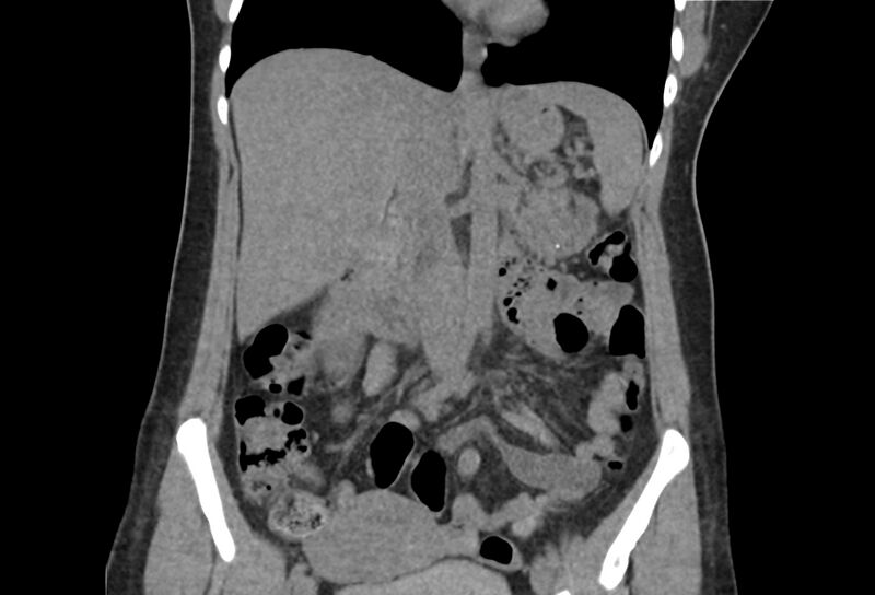 File:Chronic pancreatitis - pancreatic duct calculi (Radiopaedia 71818-82251 Coronal non-contrast 21).jpg