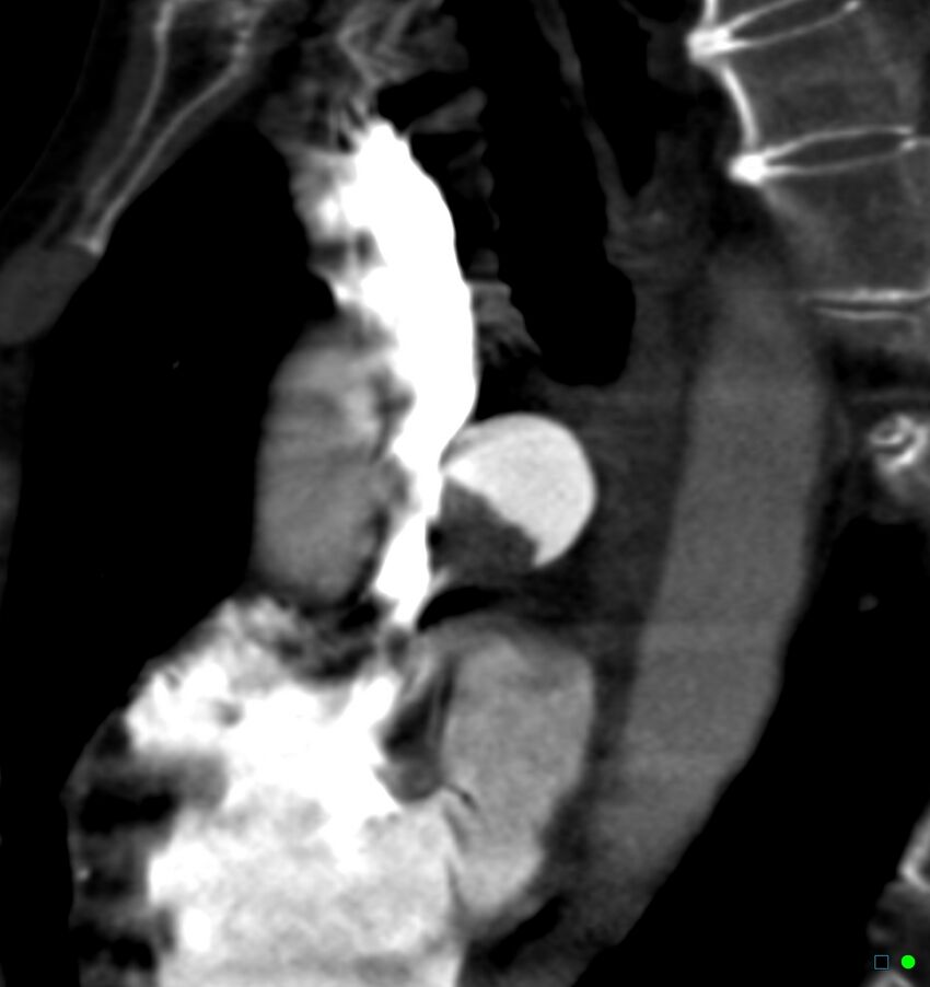 Chronic pulmonary embolism (Radiopaedia 17943-17702 Sagittal C+ CTPA 4).jpg