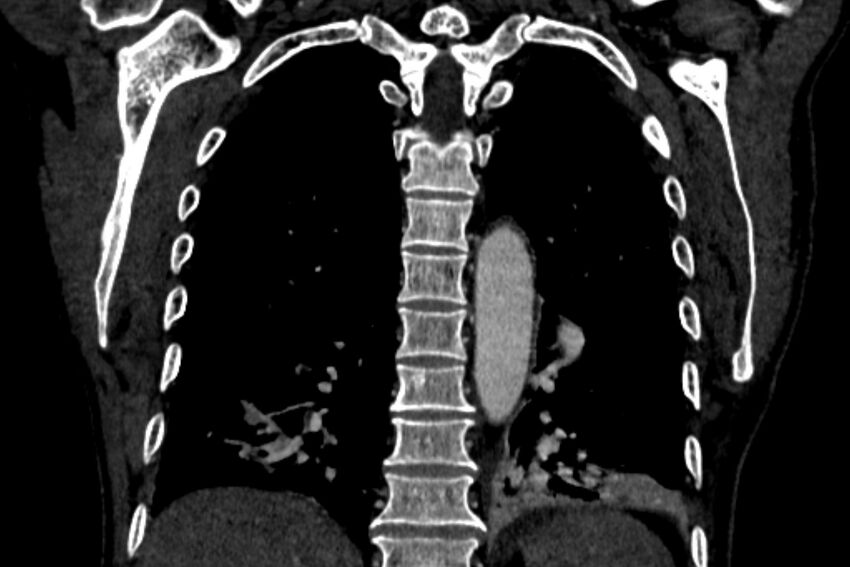 Chronic pulmonary embolism with bubbly consolidation (Radiopaedia 91248-108850 B 106).jpg