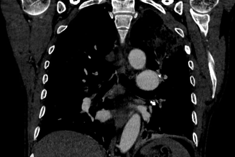 File:Chronic pulmonary embolism with bubbly consolidation (Radiopaedia 91248-108850 B 89).jpg