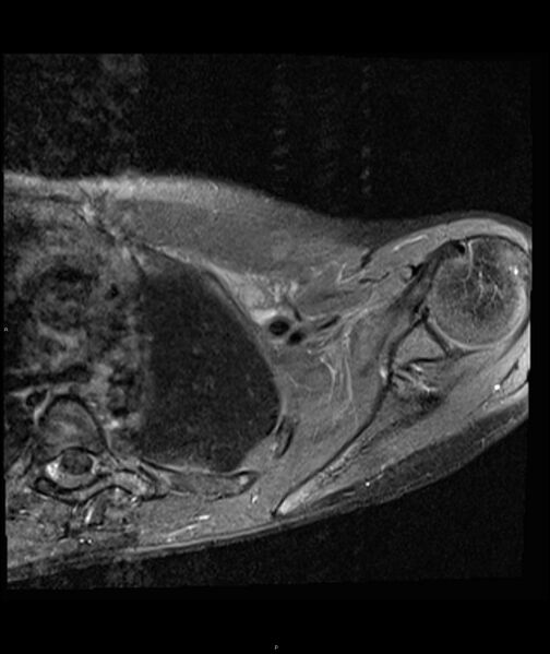 File:Chronic reactive multifocal osteomyelitis (CRMO) - clavicle (Radiopaedia 56406-63071 Axial T1 C+ fat sat 15).jpg