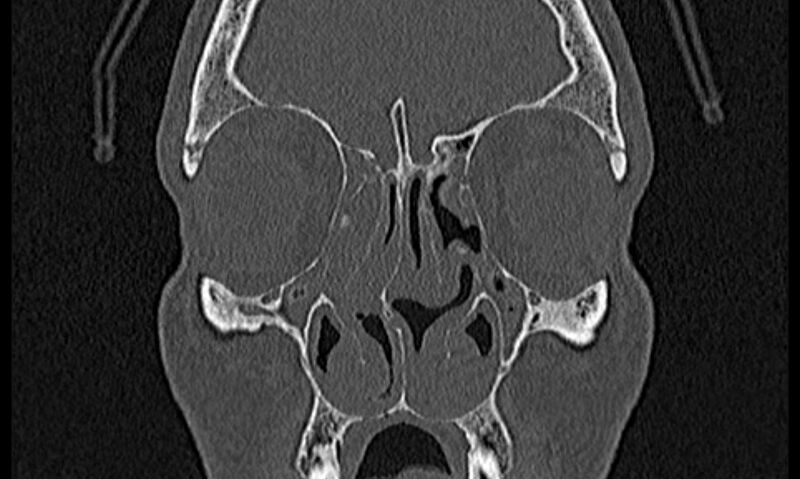 File:Chronic rhinosinusitis (Radiopaedia 65079-74075 Coronal bone window 26).jpg