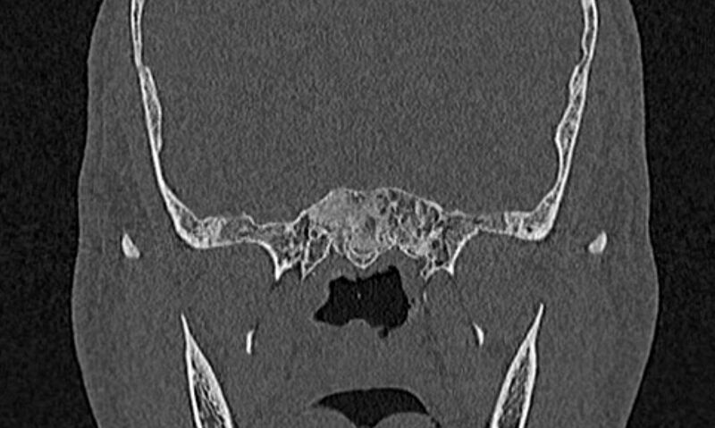 File:Chronic rhinosinusitis (Radiopaedia 65079-74075 Coronal bone window 76).jpg