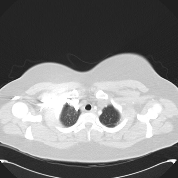 File:Chronic thromboembolic pulmonary hypertension (CTEPH) (Radiopaedia 74597-85531 Axial lung window 8).jpg