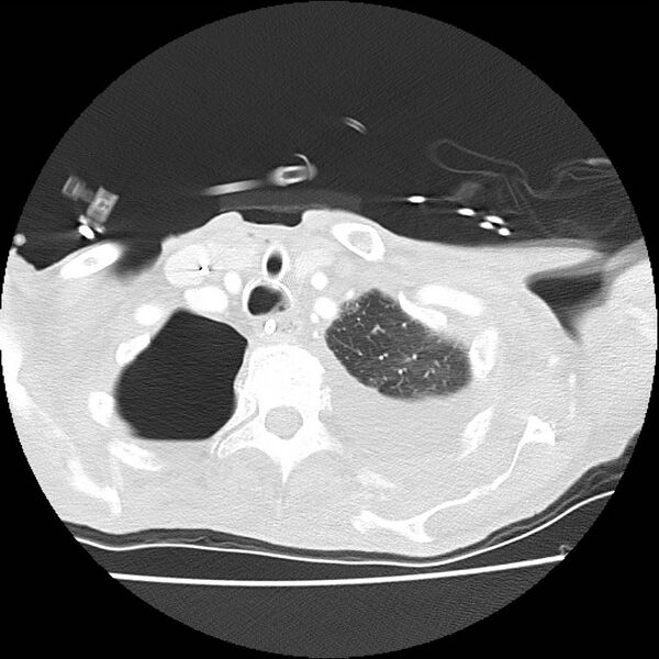File:Clagett thoracotomy with bronchopleural fistula (Radiopaedia 29192-29587 Axial lung window 4).jpg