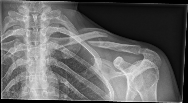 File:Clavicle fracture (Radiopaedia 62007-70092 B 1).png