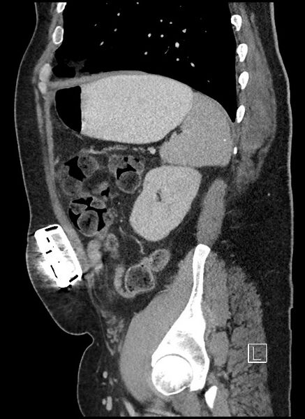 File:Closed loop obstruction - internal hernia into nephrectomy bed (Radiopaedia 59867-67320 C 16).jpg